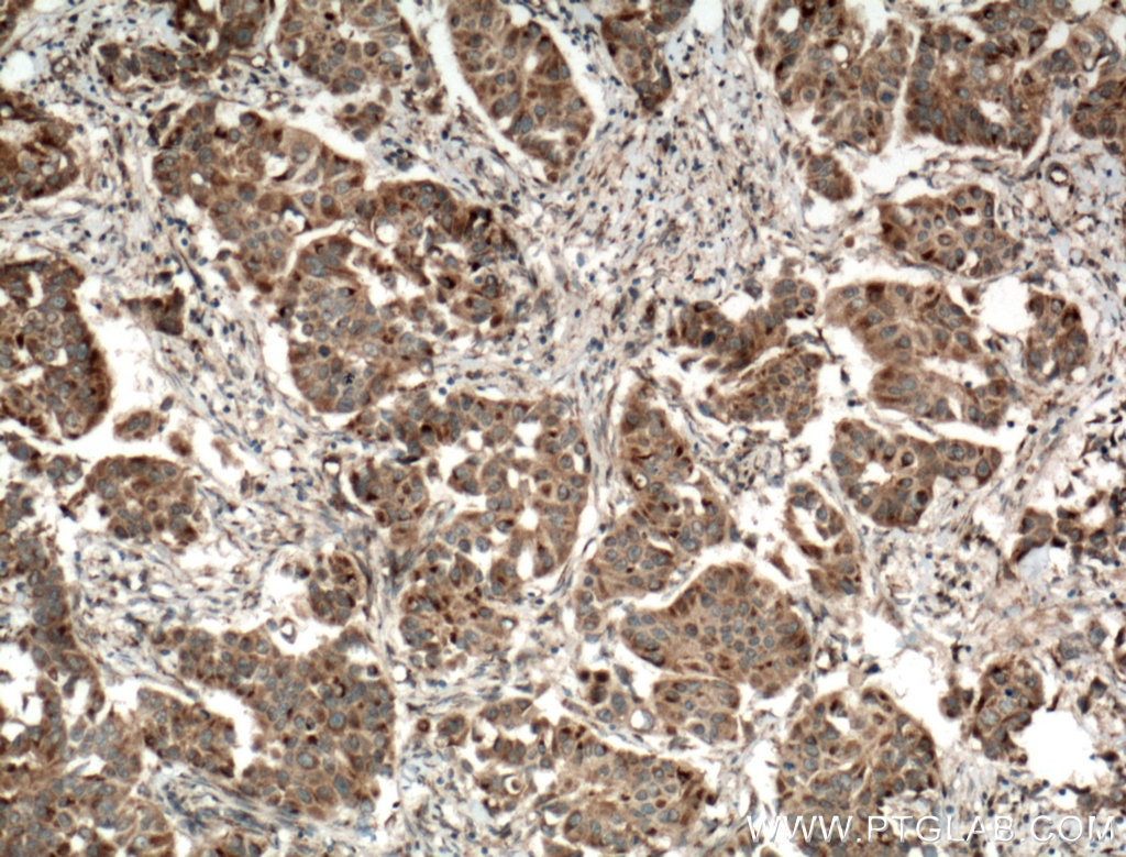 Immunohistochemistry (IHC) staining of human breast cancer tissue using SYTL4 Polyclonal antibody (12128-1-AP)