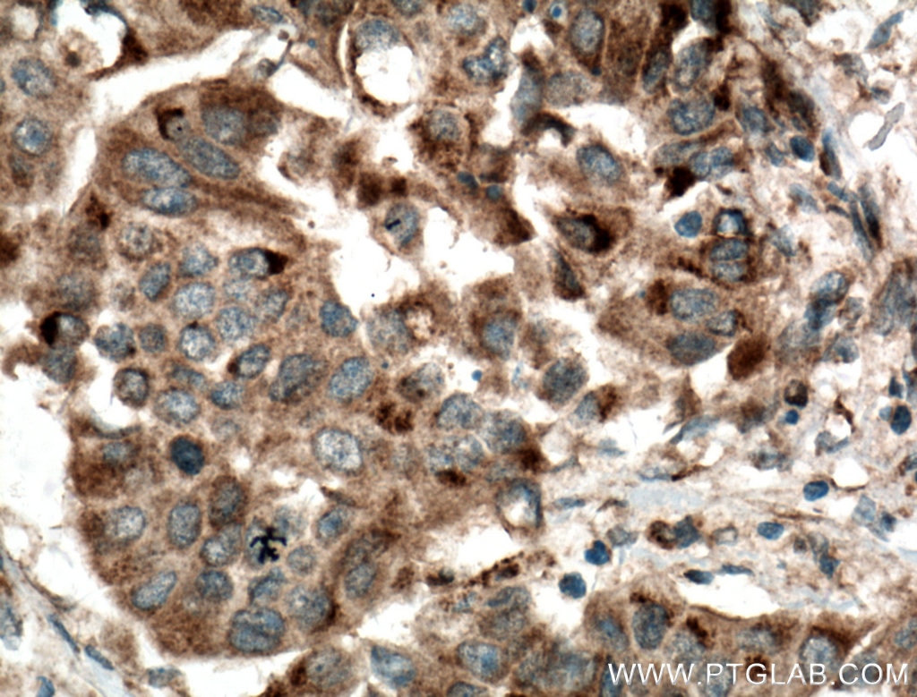 Immunohistochemistry (IHC) staining of human breast cancer tissue using SYTL4 Polyclonal antibody (12128-1-AP)