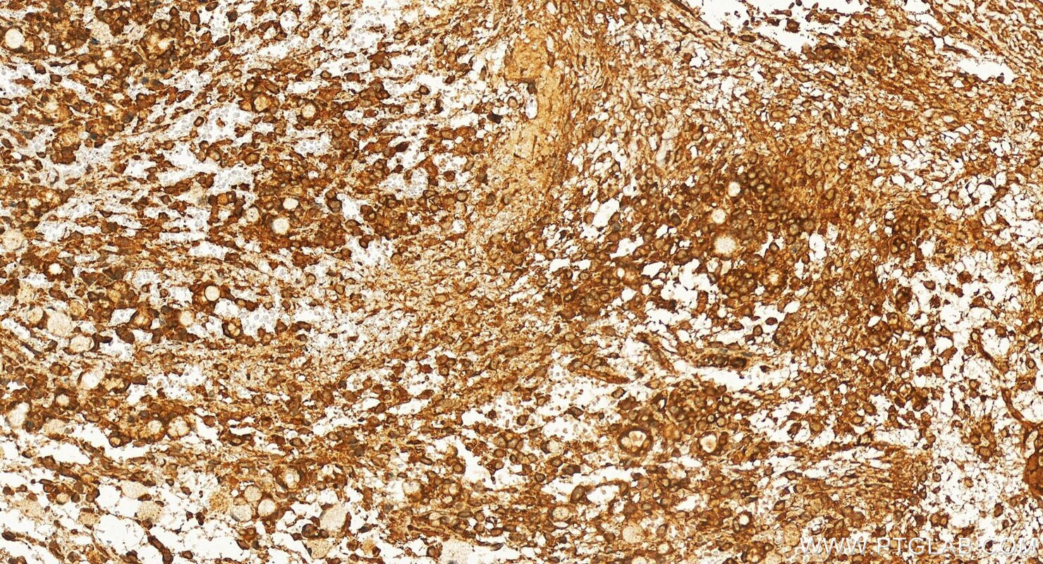 Immunohistochemistry (IHC) staining of human ovary cancer tissue using SZRD1 Polyclonal antibody (24844-1-AP)