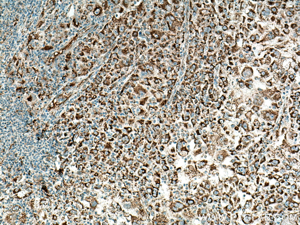 Immunohistochemistry (IHC) staining of human liver cancer tissue using Sam50 Polyclonal antibody (28679-1-AP)