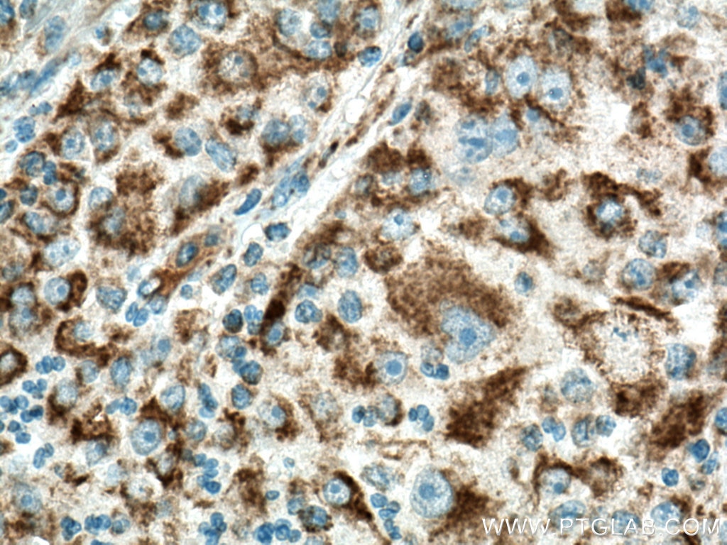 Immunohistochemistry (IHC) staining of human liver cancer tissue using Sam50 Polyclonal antibody (28679-1-AP)