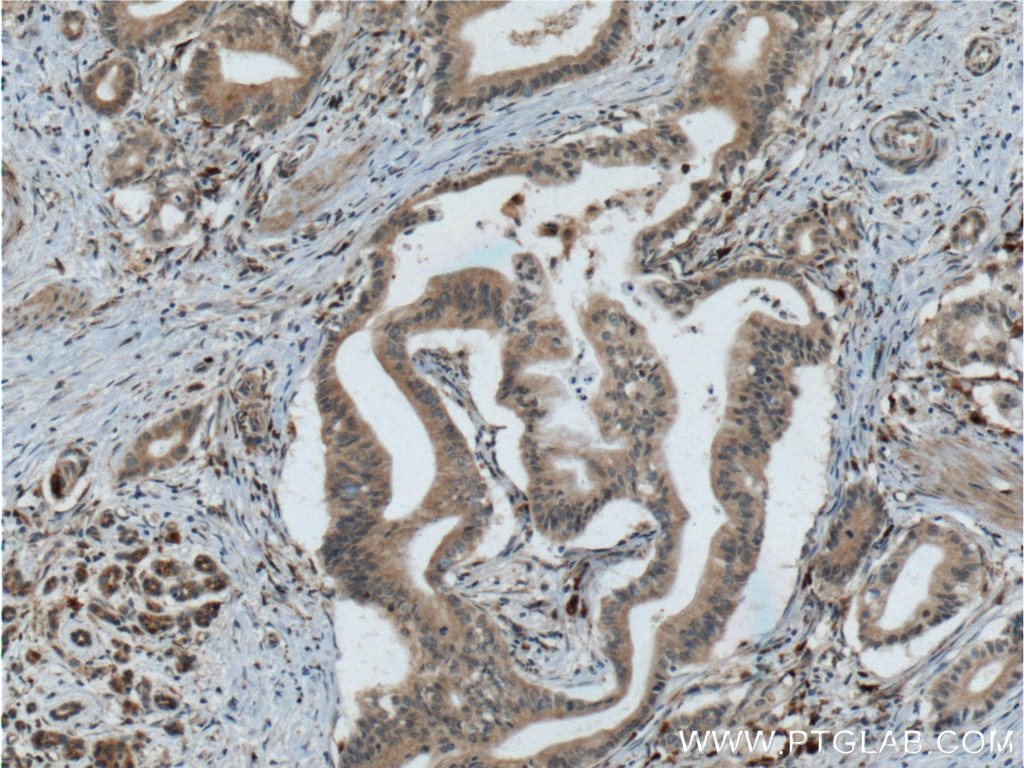 Immunohistochemistry (IHC) staining of human pancreas cancer tissue using RISC Monoclonal antibody (60086-1-Ig)