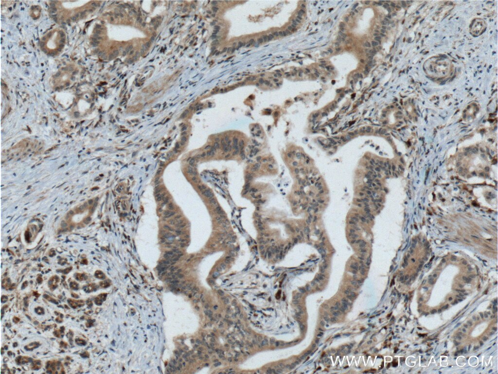 Immunohistochemistry (IHC) staining of human pancreas cancer tissue using RISC Monoclonal antibody (60086-1-Ig)