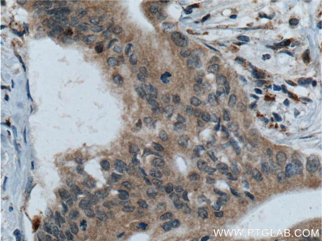 Immunohistochemistry (IHC) staining of human pancreas cancer tissue using RISC Monoclonal antibody (60086-1-Ig)