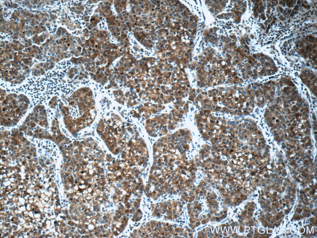 Immunohistochemistry (IHC) staining of human liver cancer tissue using SCT Polyclonal antibody (23125-1-AP)