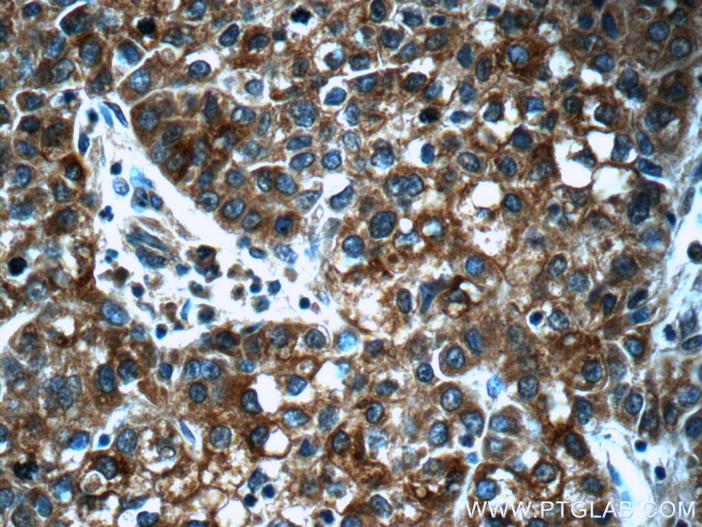 Immunohistochemistry (IHC) staining of human liver cancer tissue using SCT Polyclonal antibody (23125-1-AP)
