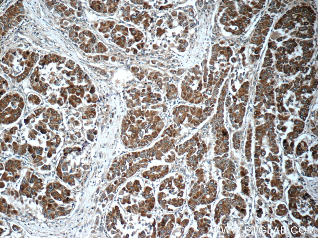 Immunohistochemistry (IHC) staining of human liver cancer tissue using SCT Polyclonal antibody (23125-1-AP)