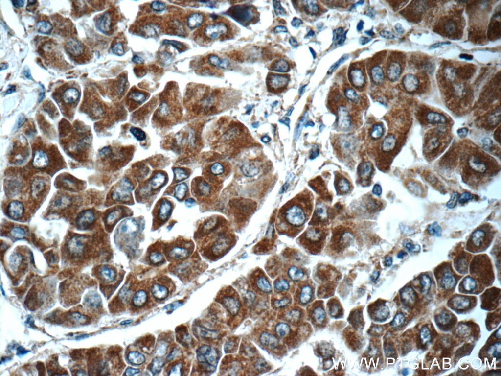 Immunohistochemistry (IHC) staining of human liver cancer tissue using SCT Polyclonal antibody (23125-1-AP)