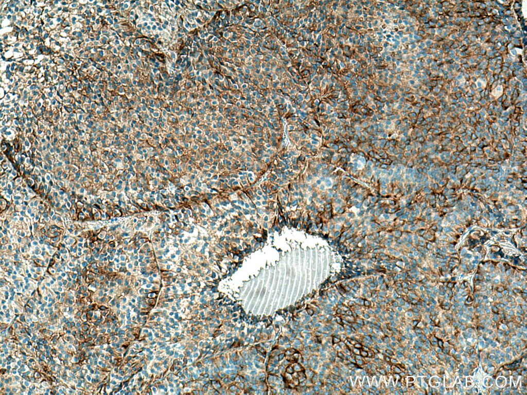 Immunohistochemistry (IHC) staining of human pituitary adenoma tissue using Secretogranin V Monoclonal antibody (67406-1-Ig)