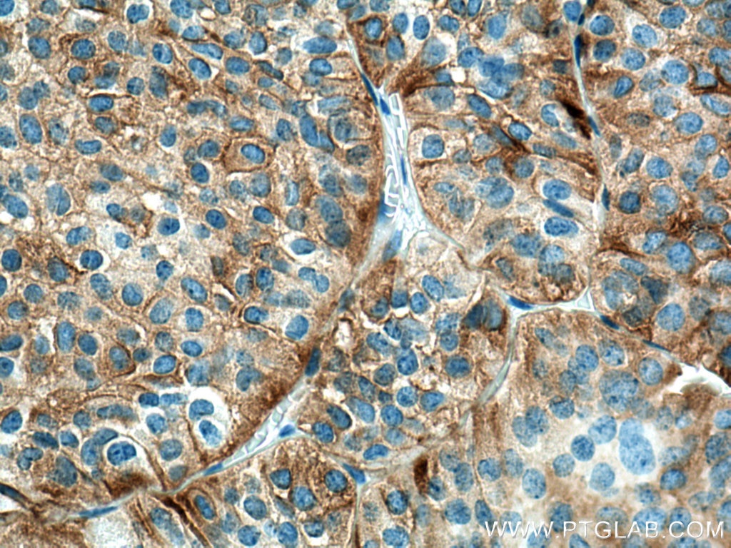 Immunohistochemistry (IHC) staining of human pituitary adenoma tissue using Secretogranin V Monoclonal antibody (67406-1-Ig)