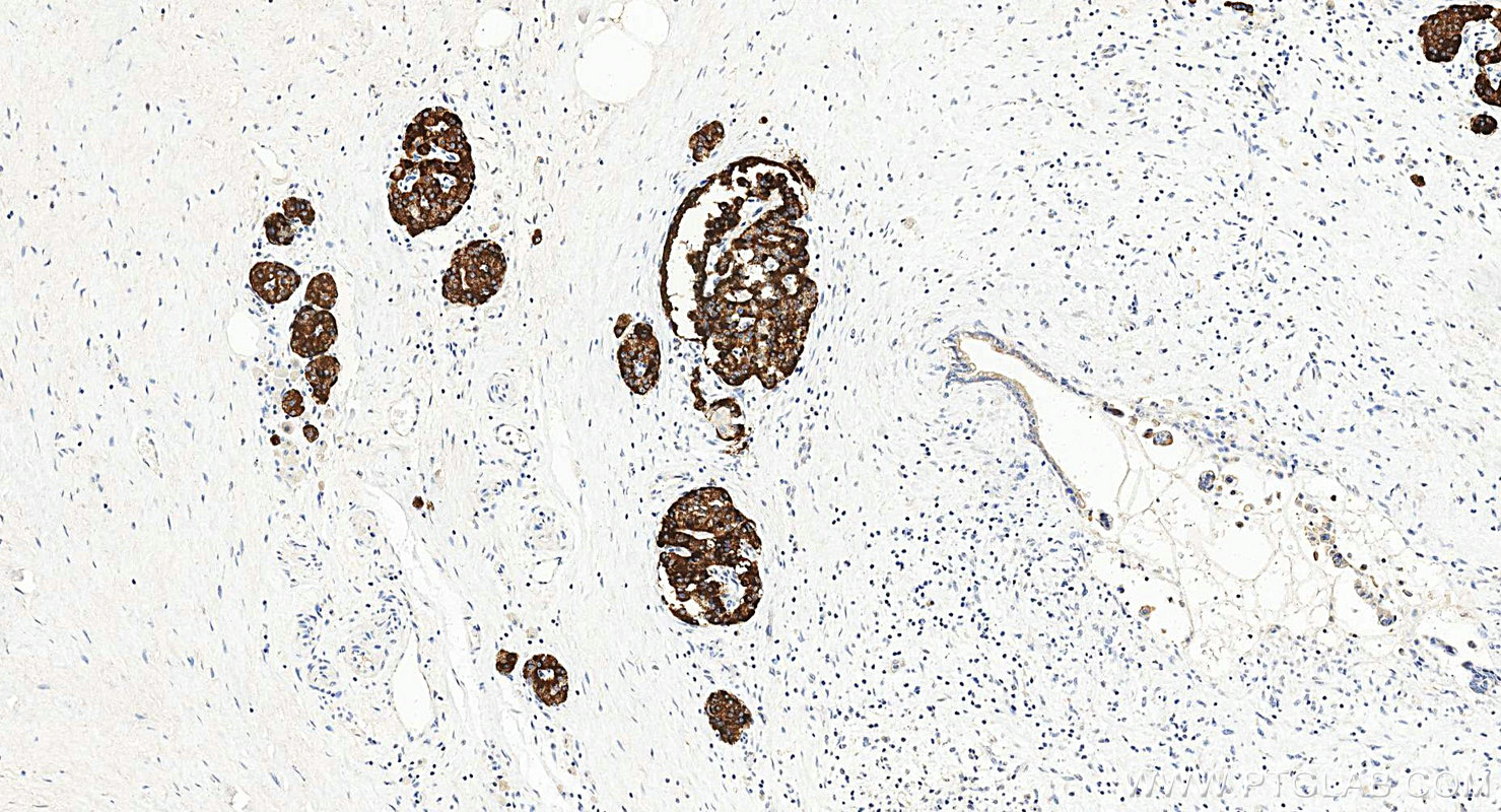 IHC staining of human pancreas using 67406-1-Ig Immunohistochemistry (IHC) staining of human pancreas tissue using Secretogranin V Monoclonal antibody (67406-1-Ig)