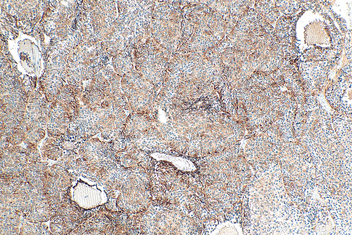 IHC staining of human pituitary adenoma using 67406-1-Ig Immunohistochemistry (IHC) staining of human pituitary adenoma tissue using Secretogranin V Monoclonal antibody (67406-1-Ig)