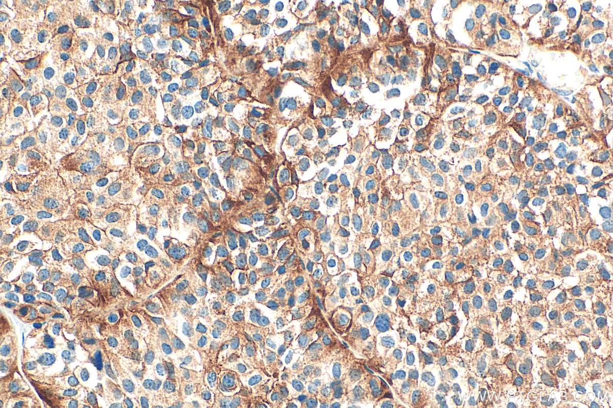 IHC staining of human pituitary adenoma using 67406-1-Ig Immunohistochemistry (IHC) staining of human pituitary adenoma tissue using Secretogranin V Monoclonal antibody (67406-1-Ig)
