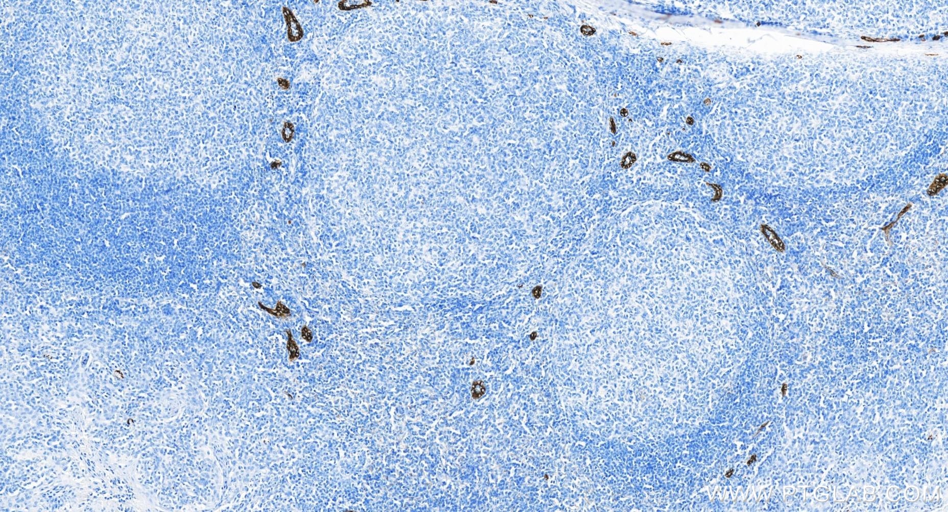 Immunohistochemistry (IHC) staining of human tonsillitis tissue using P-Selectin/CD62P Recombinant antibody (83947-5-RR)