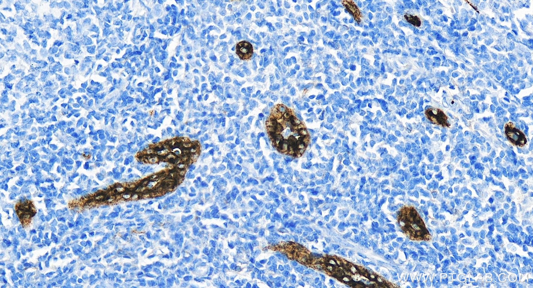 Immunohistochemistry (IHC) staining of human tonsillitis tissue using P-Selectin/CD62P Recombinant antibody (83947-5-RR)