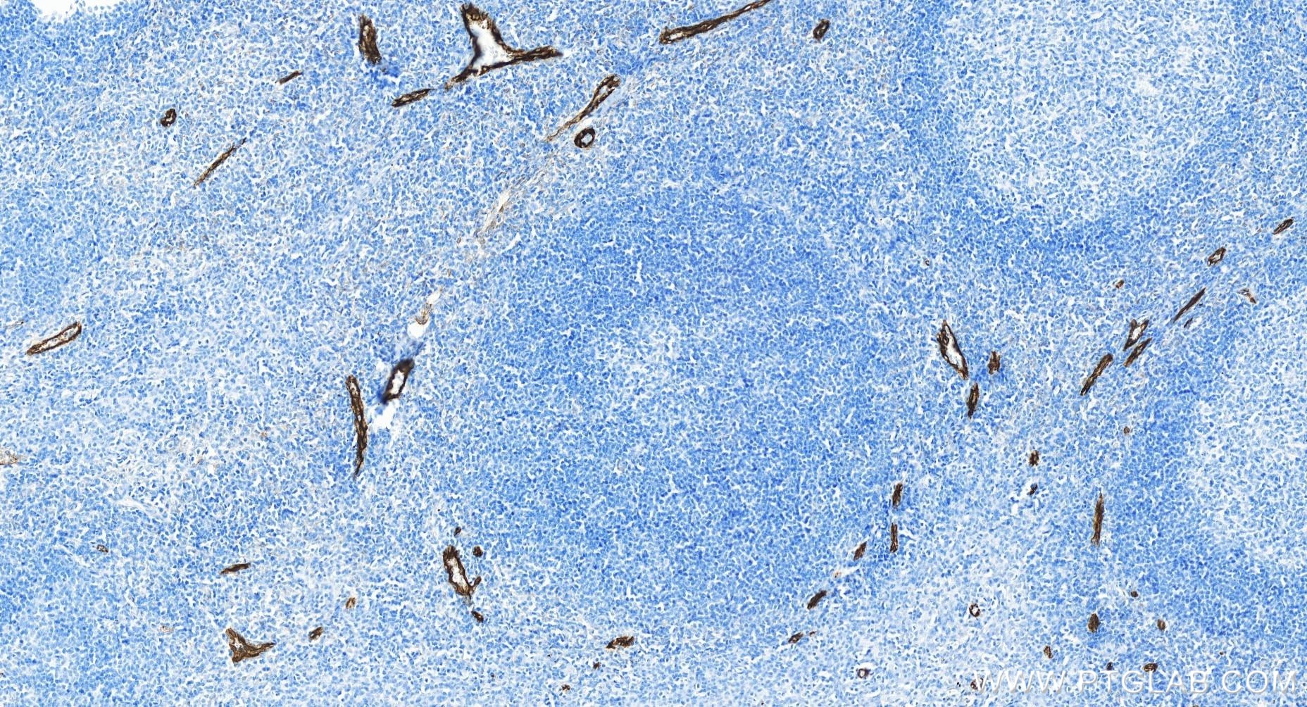 Immunohistochemistry (IHC) staining of human tonsillitis tissue using P-Selectin/CD62P Recombinant antibody (83947-5-RR)