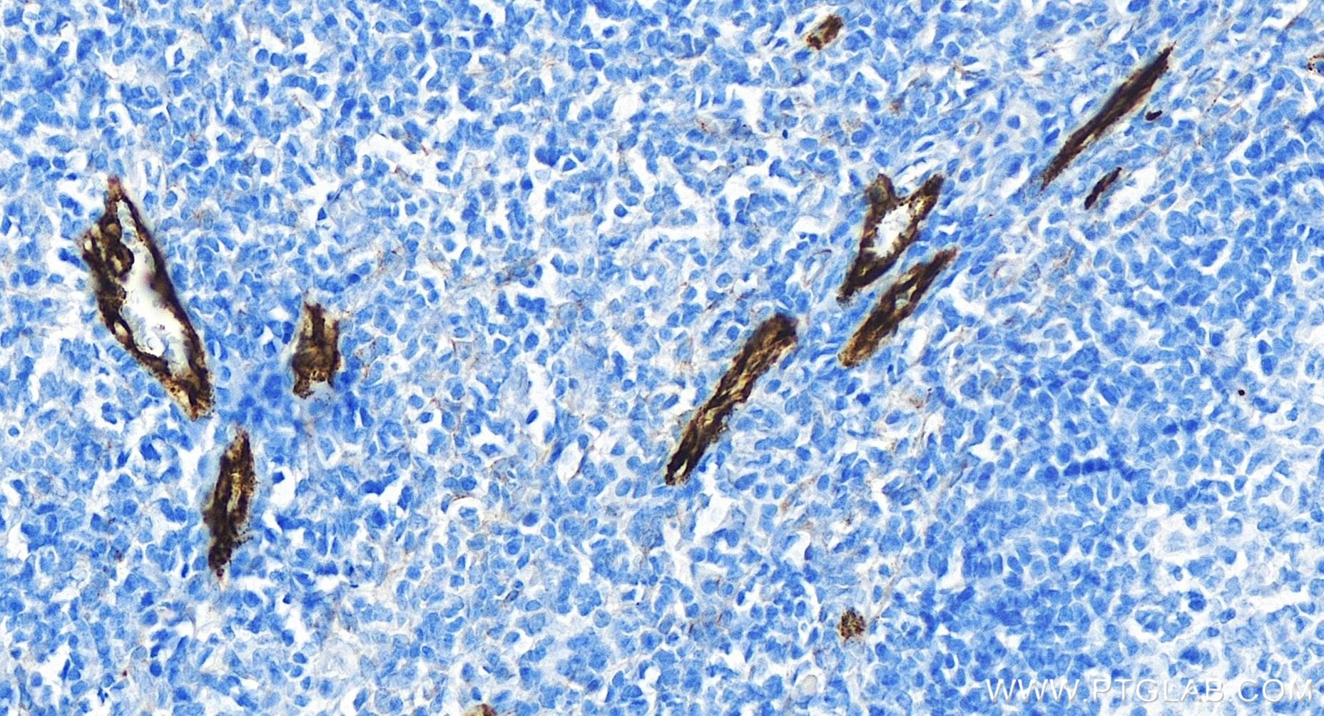 Immunohistochemical analysis of paraffin-embedded human tonsillitis tissue slide using 83947-5-RR (P-Selectin/CD62P antibody) at dilution of 1:800 (under 40x lens). Heat mediated antigen retrieval with Tris-EDTA buffer (pH 9.0). Immunohistochemistry (IHC) staining of human tonsillitis tissue using P-Selectin/CD62P Recombinant monoclonal antibody (83947-5-RR)