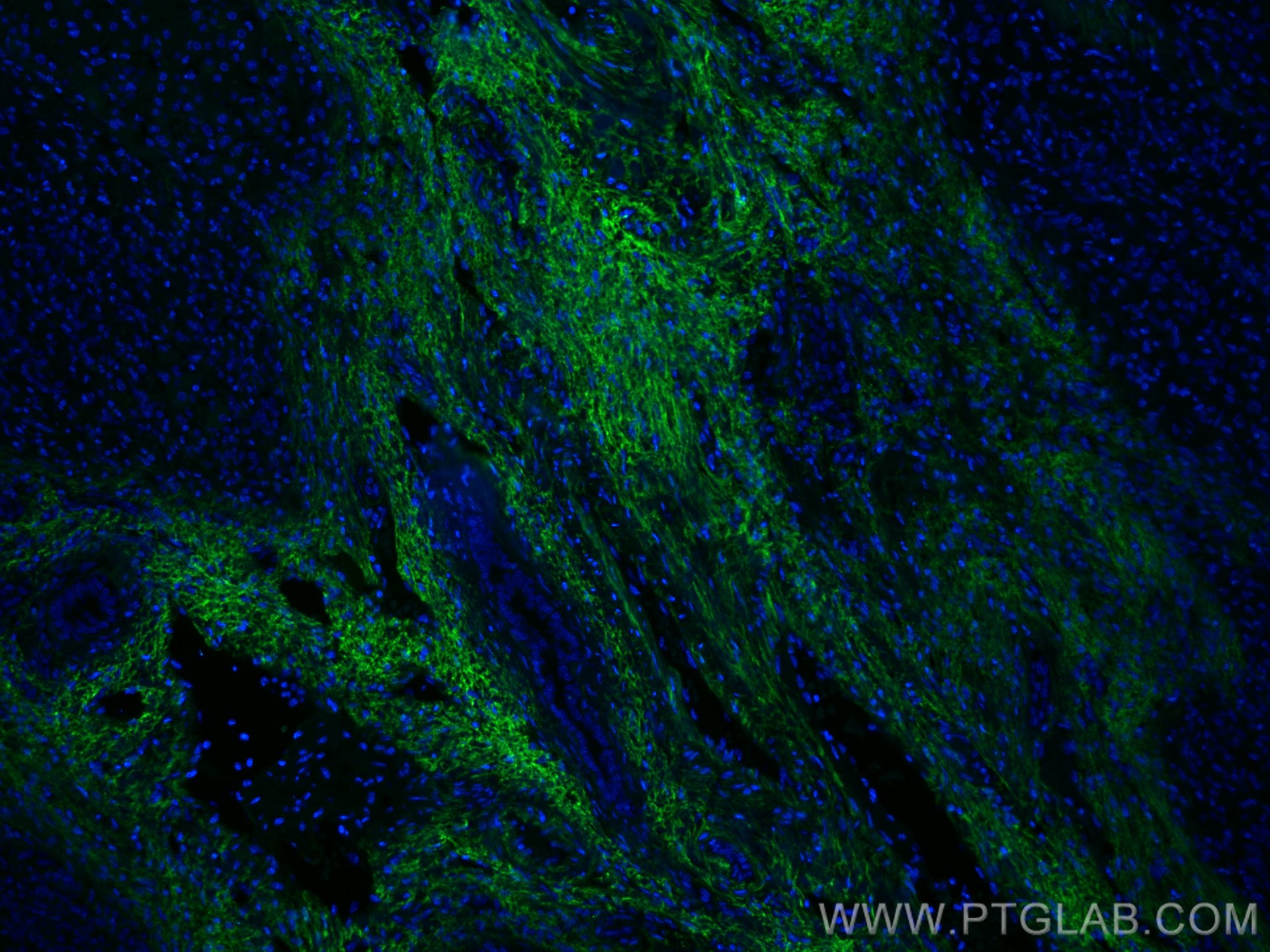 Immunofluorescence (IF) / fluorescent staining of human liver cancer tissue using CoraLite® Plus 488-conjugated Serum amyloid P comp (CL488-66084)