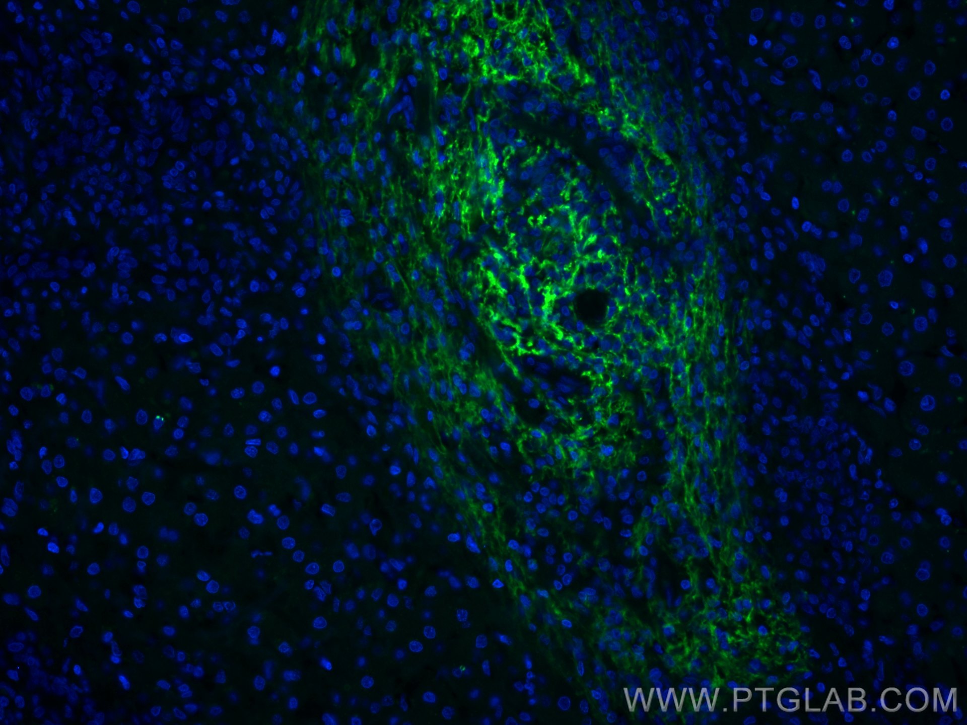 Immunofluorescence (IF) / fluorescent staining of human liver cancer tissue using CoraLite® Plus 488-conjugated Serum amyloid P comp (CL488-66084)