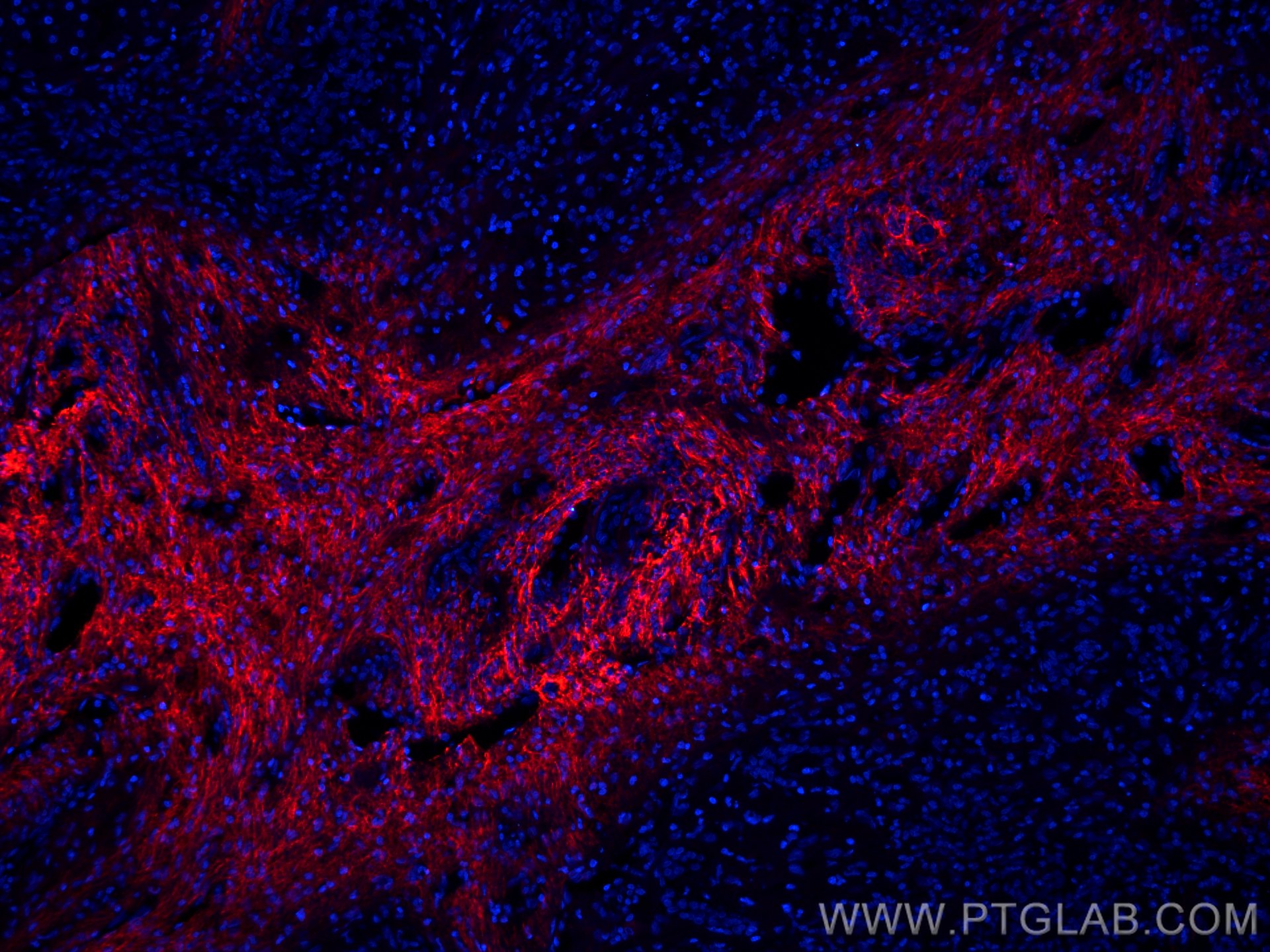 Immunofluorescence (IF) / fluorescent staining of human liver cancer tissue using CoraLite®594-conjugated Serum amyloid P component  (CL594-66084)