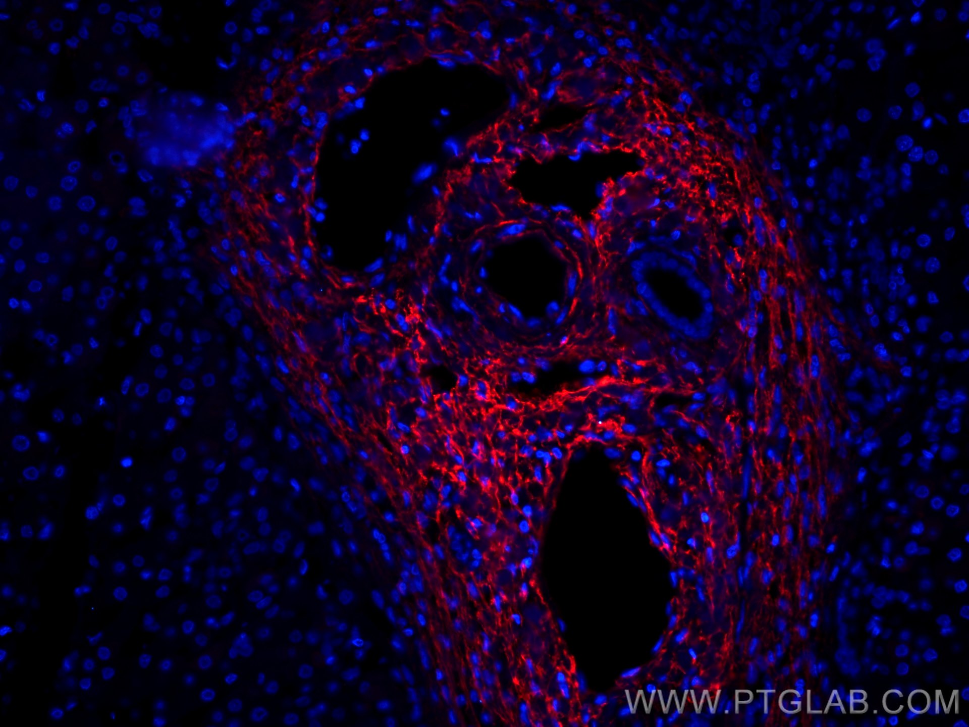 Immunofluorescence (IF) / fluorescent staining of human liver cancer tissue using CoraLite®594-conjugated Serum amyloid P component  (CL594-66084)