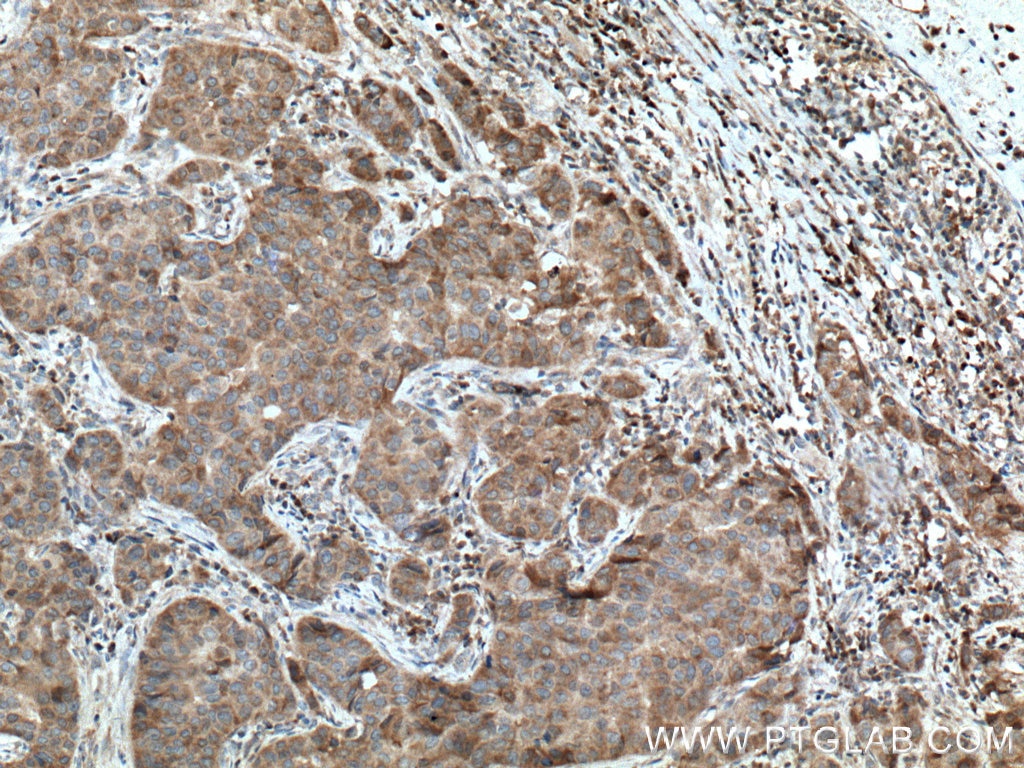 Immunohistochemistry (IHC) staining of human breast cancer tissue using Sestrin 2 Polyclonal antibody (10795-1-AP)