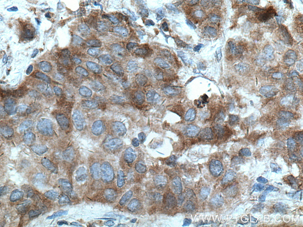 Immunohistochemistry (IHC) staining of human breast cancer tissue using Sestrin 2 Polyclonal antibody (10795-1-AP)