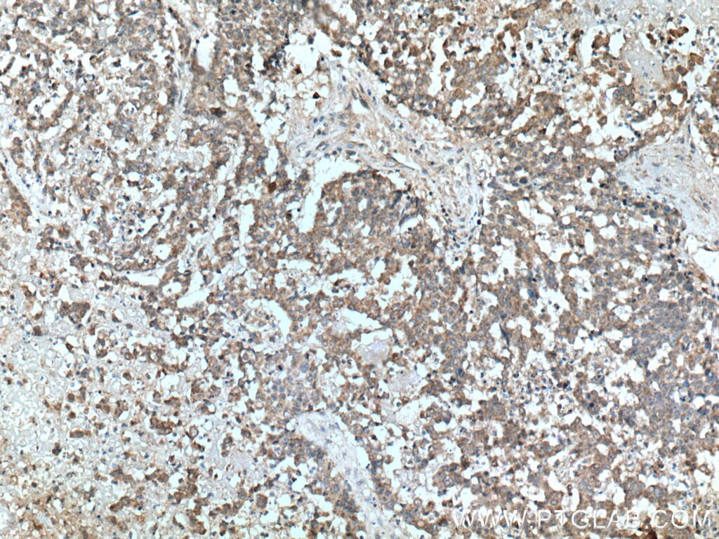 Immunohistochemistry (IHC) staining of human colon cancer tissue using Sestrin 2 Polyclonal antibody (10795-1-AP)