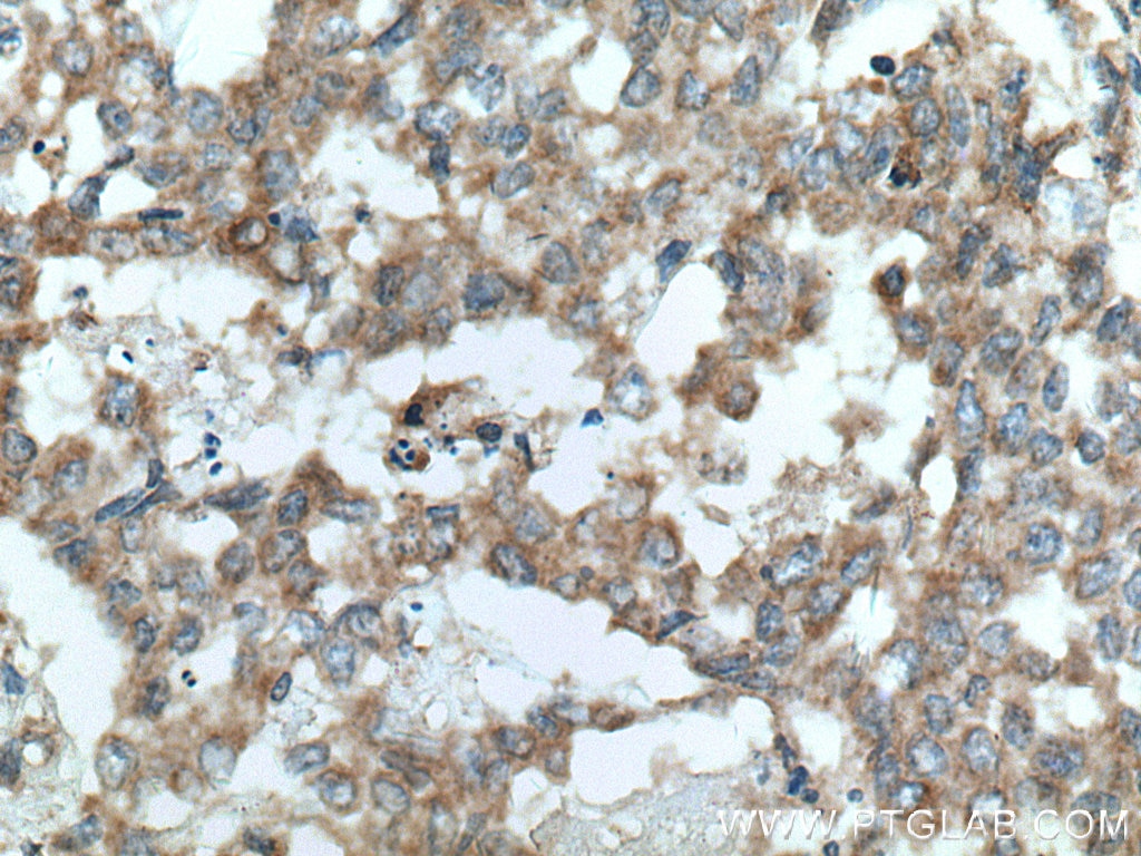 Immunohistochemistry (IHC) staining of human colon cancer tissue using Sestrin 2 Polyclonal antibody (10795-1-AP)