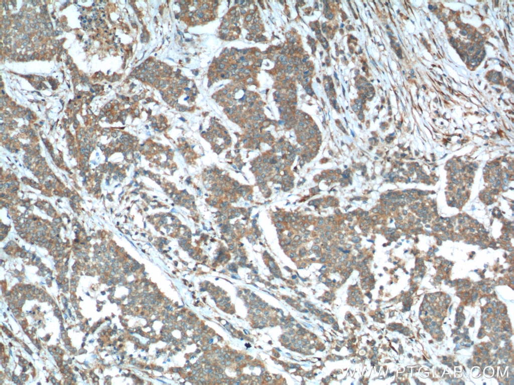 Immunohistochemistry (IHC) staining of human colon cancer tissue using Sestrin 2 Polyclonal antibody (10795-1-AP)