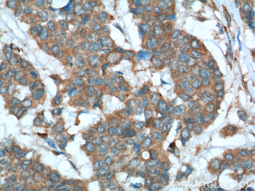 Immunohistochemistry (IHC) staining of human colon cancer tissue using Sestrin 2 Polyclonal antibody (10795-1-AP)