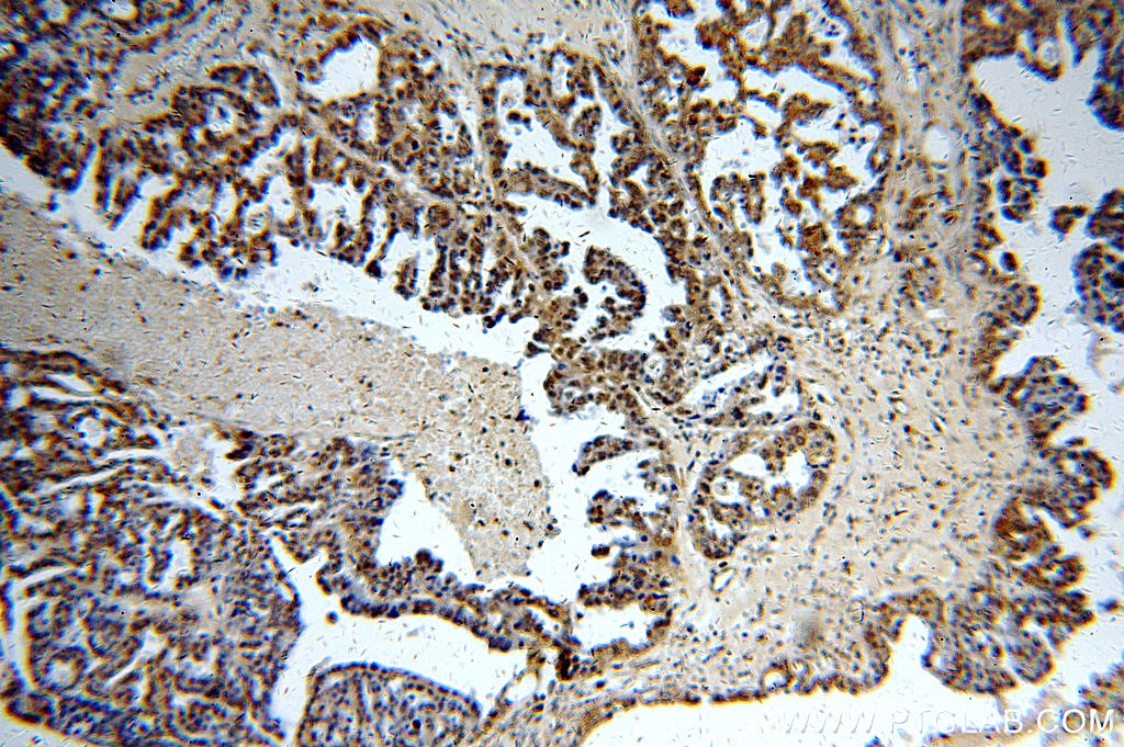 Immunohistochemistry (IHC) staining of human ovary tumor tissue using Sestrin 2 Polyclonal antibody (10795-1-AP)