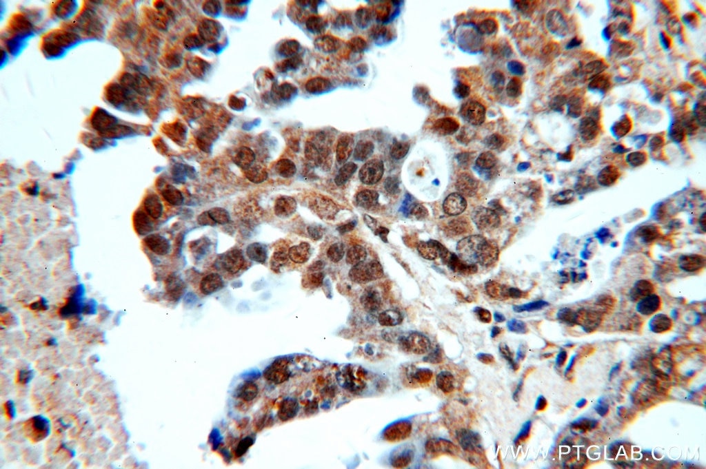 IHC staining of human ovary tumor using 10795-1-AP