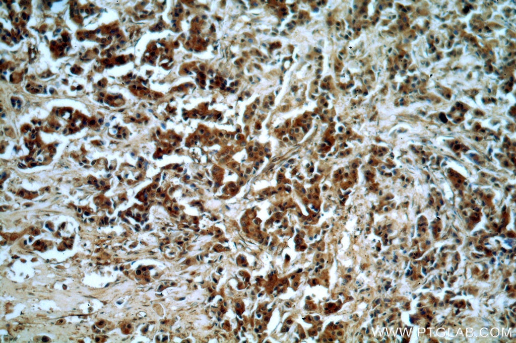 Immunohistochemistry (IHC) staining of human breast cancer tissue using Sestrin 2 Polyclonal antibody (10795-1-AP)