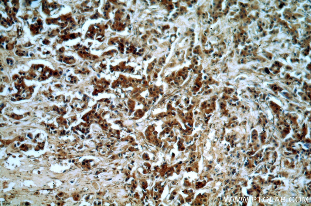 IHC staining of human breast cancer using 10795-1-AP