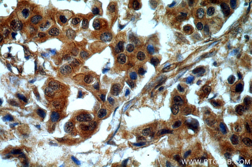 IHC staining of human breast cancer using 10795-1-AP