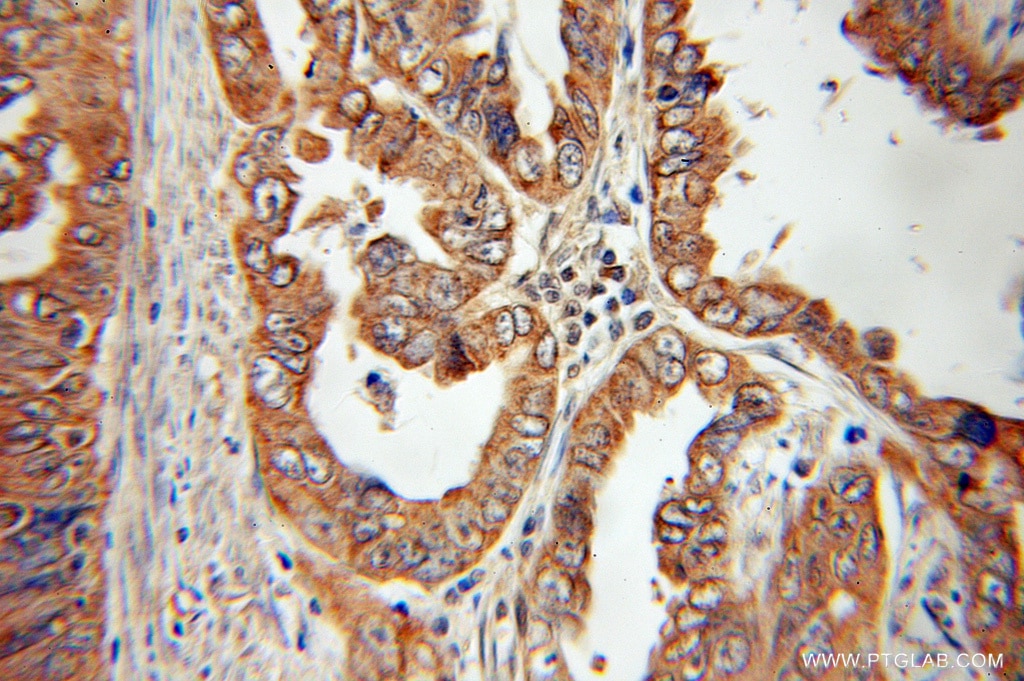 IHC staining of human ovary tumor using 10795-1-AP