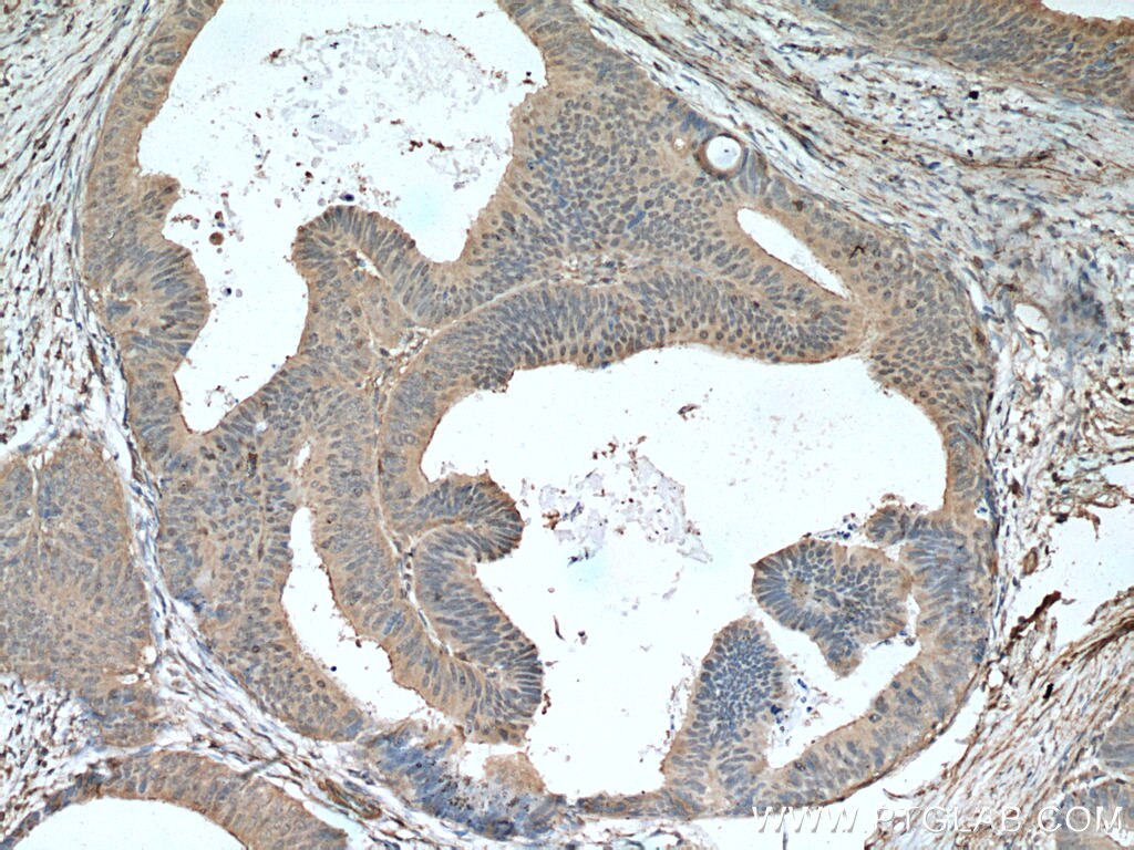 Immunohistochemistry (IHC) staining of human colon cancer tissue using Sestrin 2 Monoclonal antibody (66297-1-Ig)