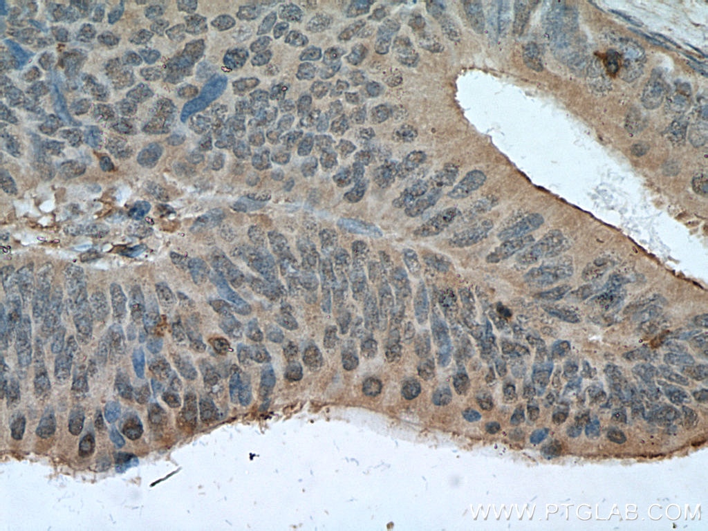 Immunohistochemistry (IHC) staining of human colon cancer tissue using Sestrin 2 Monoclonal antibody (66297-1-Ig)