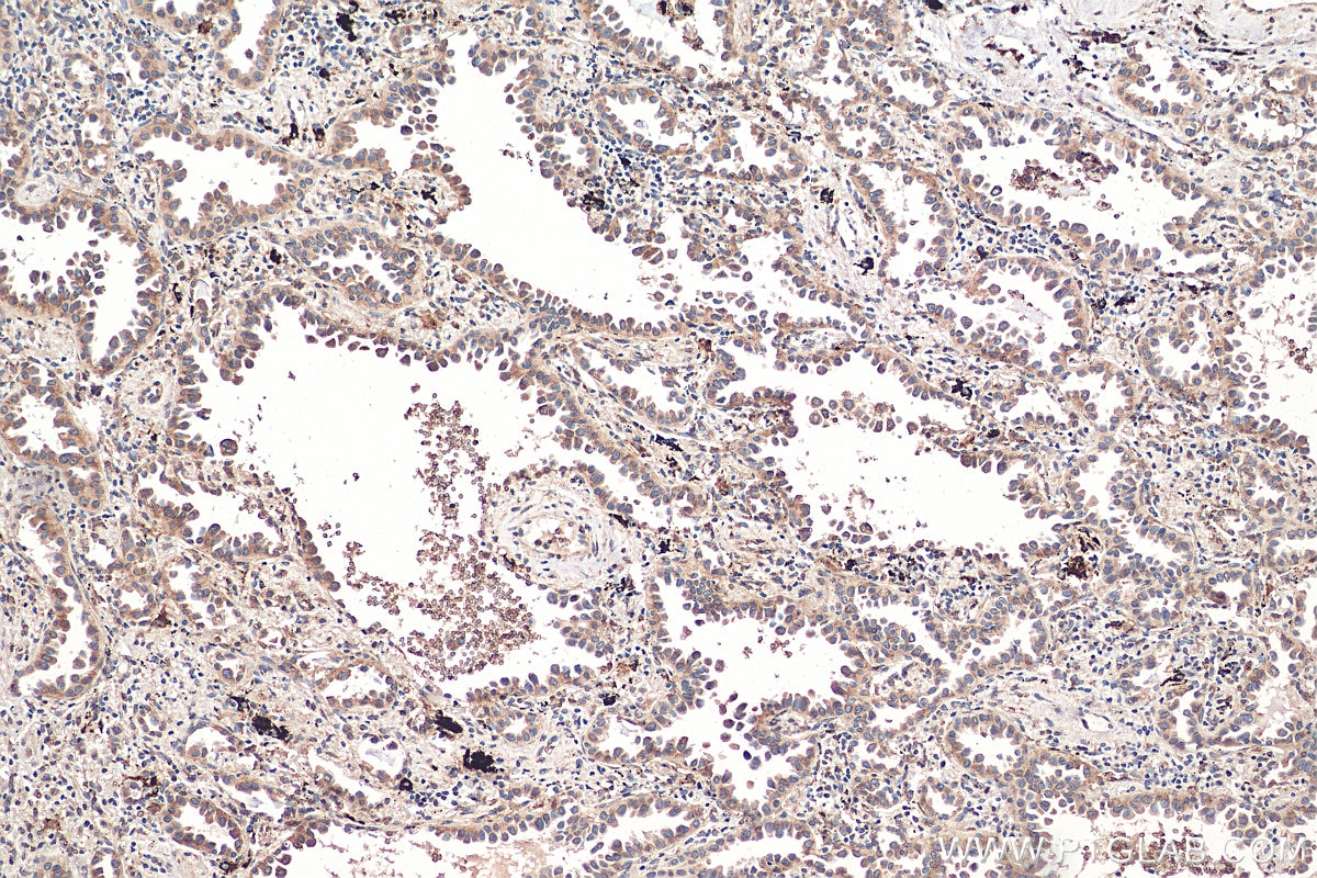 IHC staining of human lung cancer using 68007-1-Ig