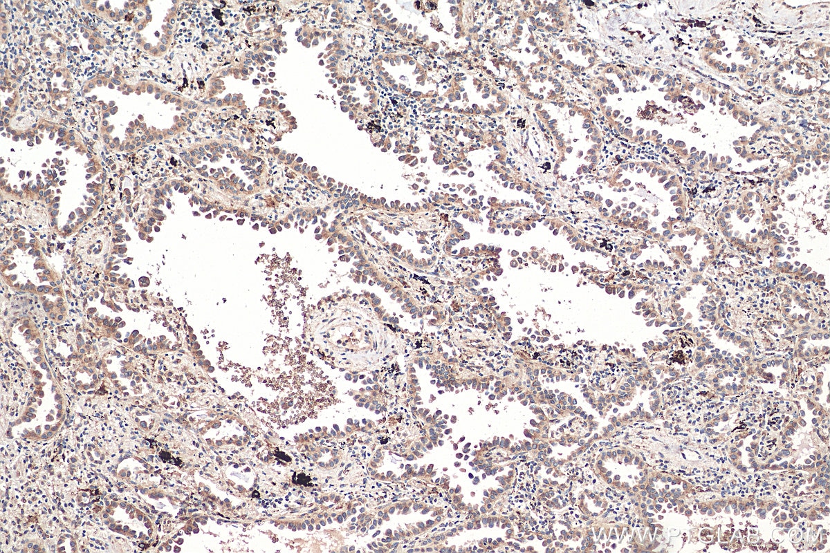 Immunohistochemistry (IHC) staining of human lung cancer tissue using Sortilin Monoclonal antibody (68007-1-Ig)