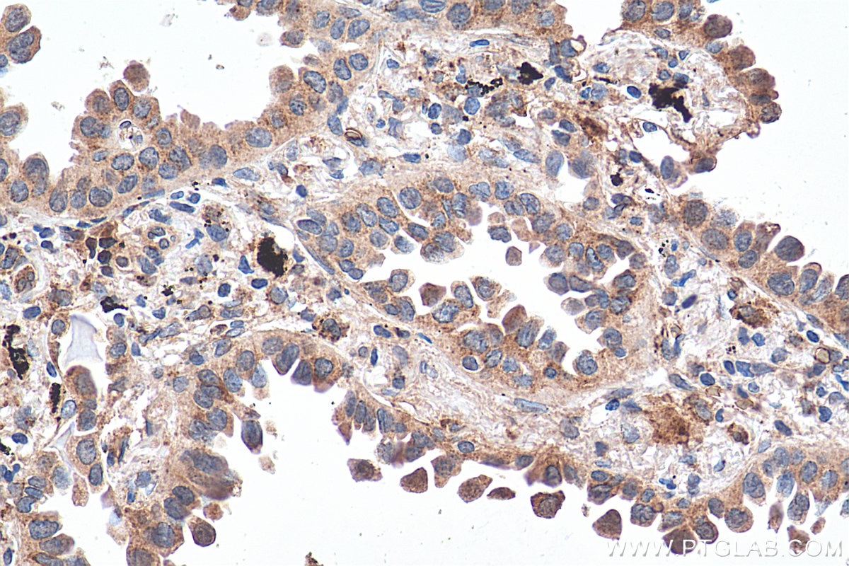 Immunohistochemistry (IHC) staining of human lung cancer tissue using Sortilin Monoclonal antibody (68007-1-Ig)