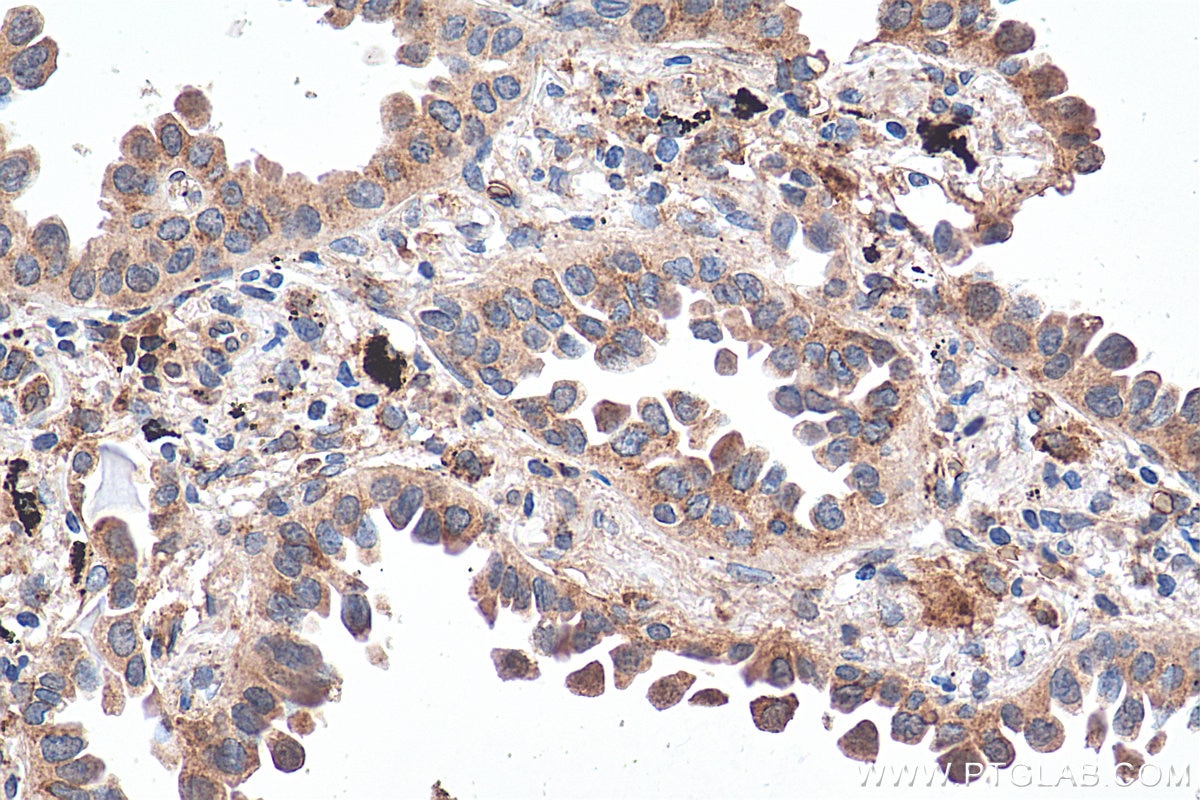 IHC staining of human lung cancer using 68007-1-Ig