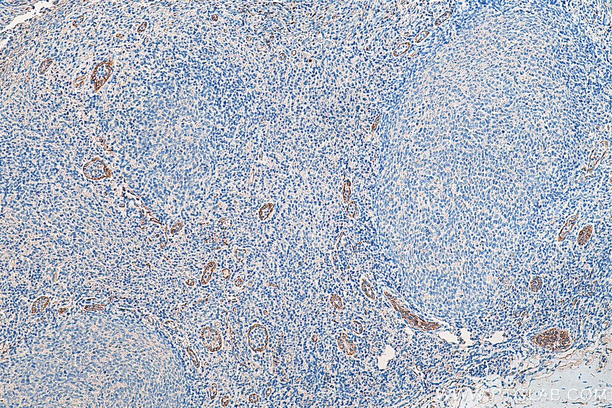 Immunohistochemistry (IHC) staining of human tonsillitis tissue using Stabilin-1 Polyclonal antibody (20663-1-AP)