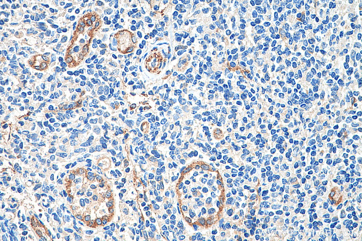 Immunohistochemistry (IHC) staining of human tonsillitis tissue using Stabilin-1 Polyclonal antibody (20663-1-AP)
