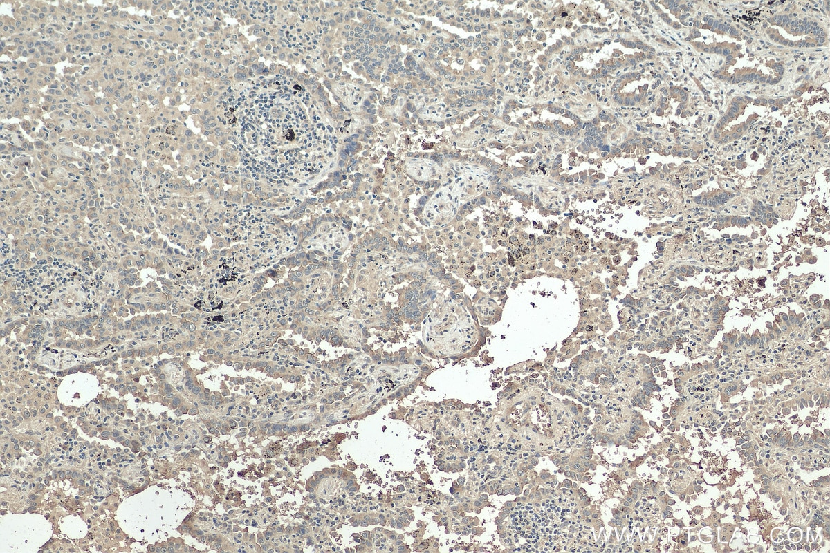 Immunohistochemistry (IHC) staining of human lung cancer tissue using Stomatin Monoclonal antibody (67894-1-Ig)