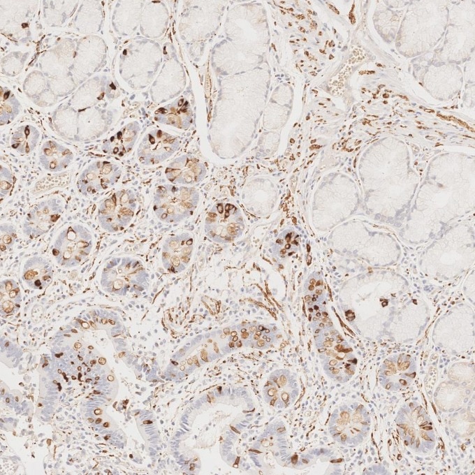 IHC staining of human stomach cancer using 67864-1-Ig Immunohistochemistry (IHC) staining of human stomach cancer tissue using Synaptophysin Monoclonal antibody (67864-1-Ig)
