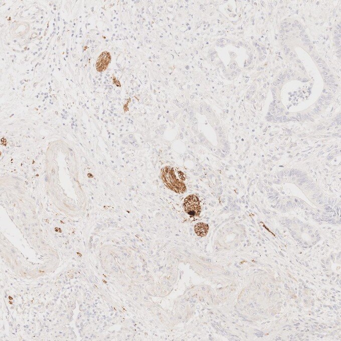 IHC staining of human colorectal cancer using 67864-1-Ig Immunohistochemistry (IHC) staining of human colorectal cancer tissue using Synaptophysin Monoclonal antibody (67864-1-Ig)