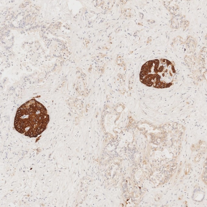 IHC staining of human pancreas cancer using 67864-1-Ig Immunohistochemistry (IHC) staining of human pancreas cancer tissue using Synaptophysin Monoclonal antibody (67864-1-Ig)