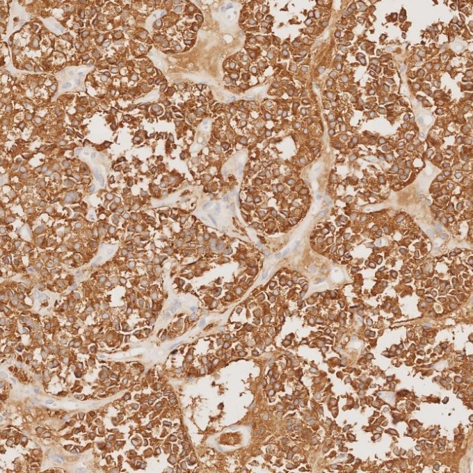 IHC staining of human pituitary adenoma using 67864-1-Ig Immunohistochemistry (IHC) staining of human pituitary adenoma tissue using Synaptophysin Monoclonal antibody (67864-1-Ig)